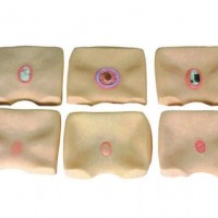 【益联医学】各期褥疮护理模型